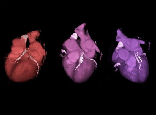 Coronary CT